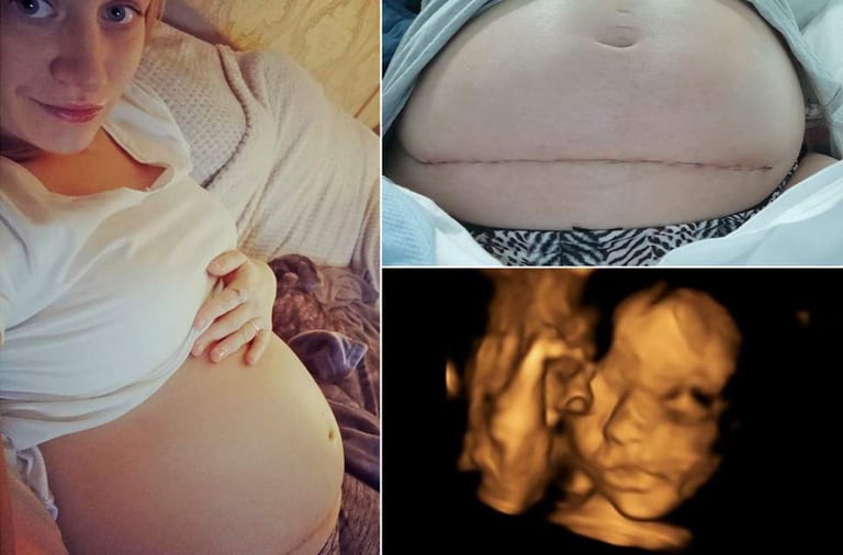 baby's spine 'repaired' in womb